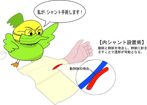 図：内シャント設置術について